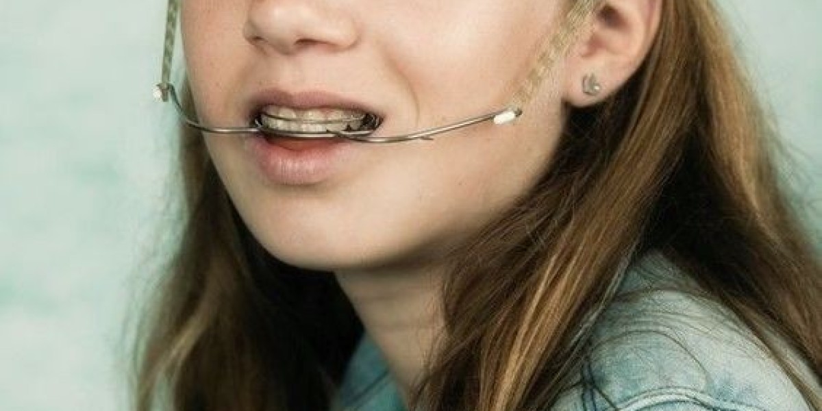 Is Headgear Better Than Braces? Exploring Options for Dental Devices in Riyadh