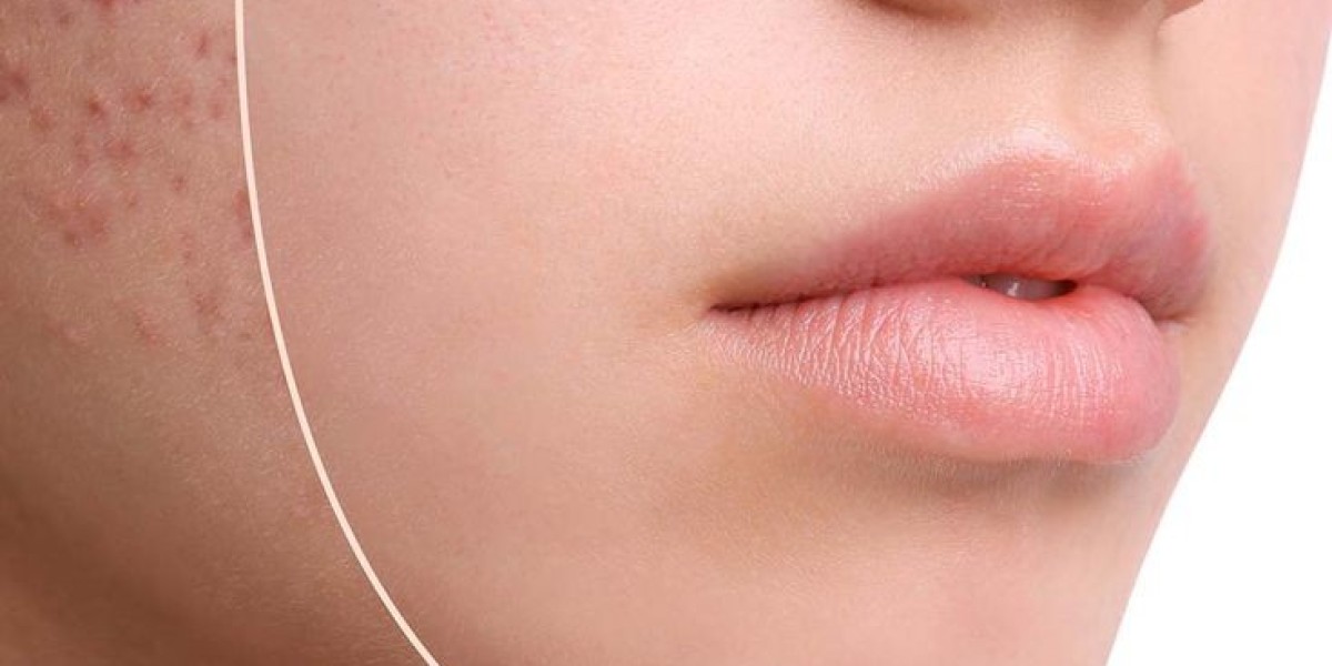 Turn Back the Clock on Acne Scars with Laser Treatments in Riyadh