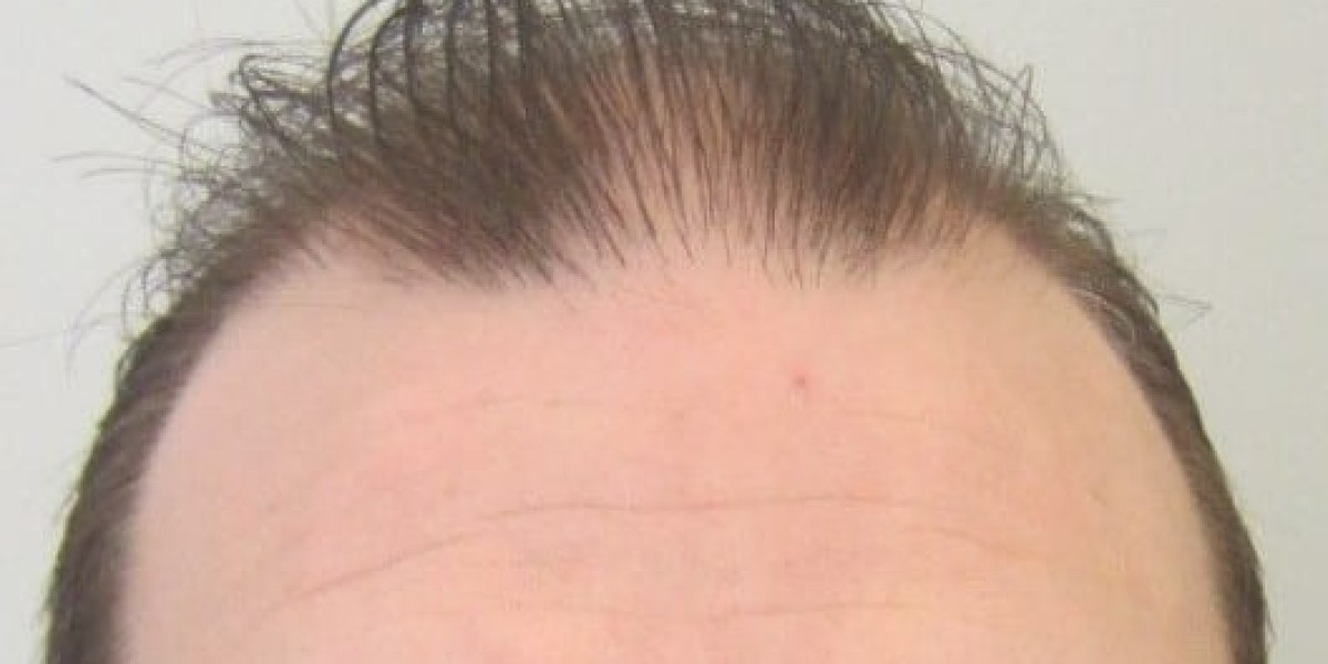 Hair Transplant in Dubai for Thinning Hair Solutions
