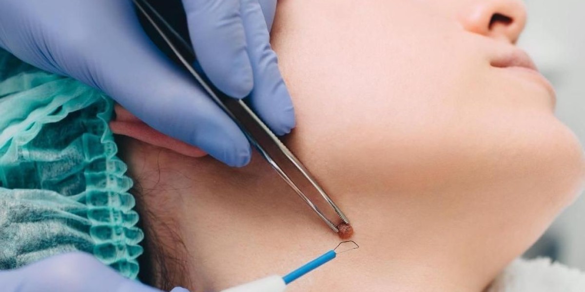 Quick and Effective Mole Removal Solutions in Riyadh