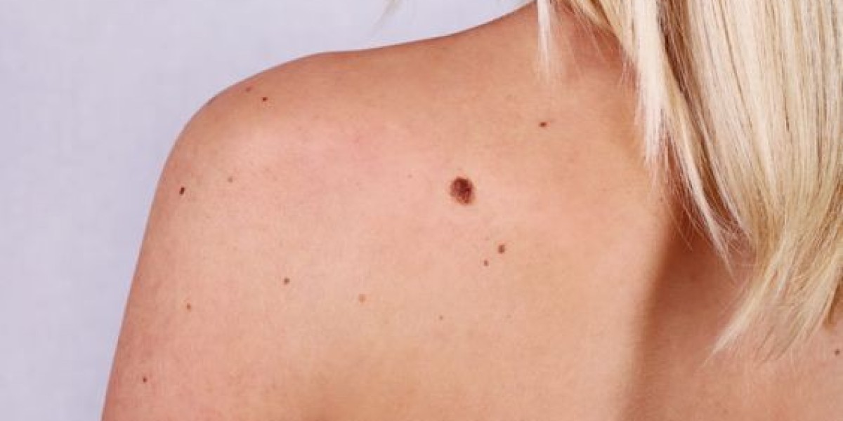 Say Farewell to Skin Tags: Expert Removal Solutions in Riyadh