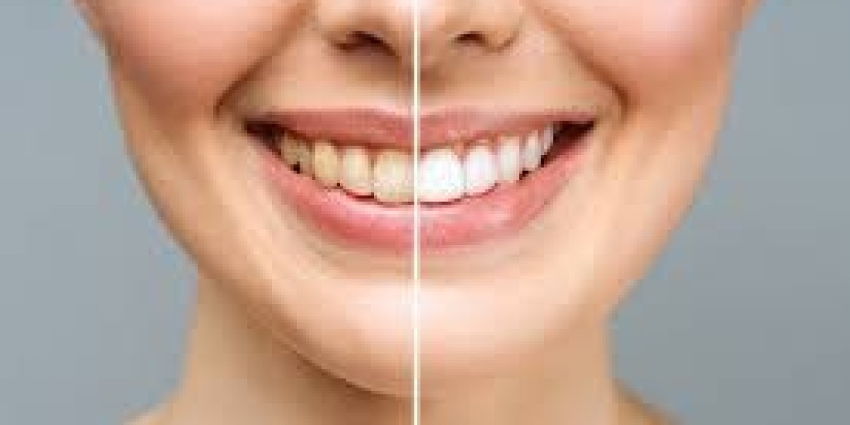 Dubai’s Top Vitamins for Preventing Yellow Teeth