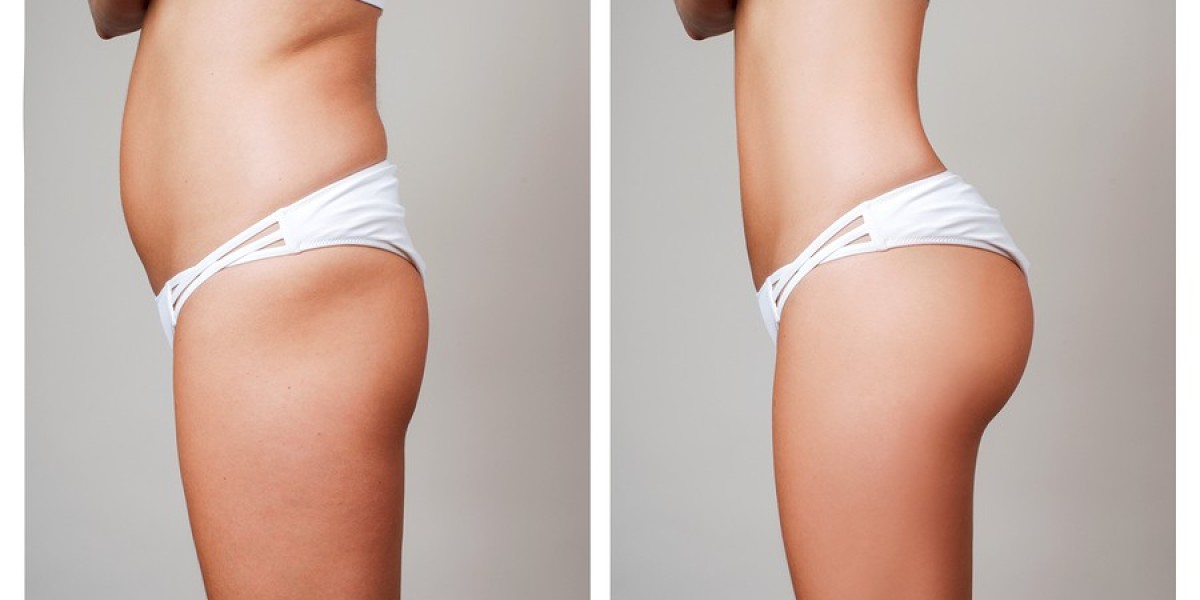 Choosing the Right Clinic for Your Brazilian Butt Lift in Riyadh