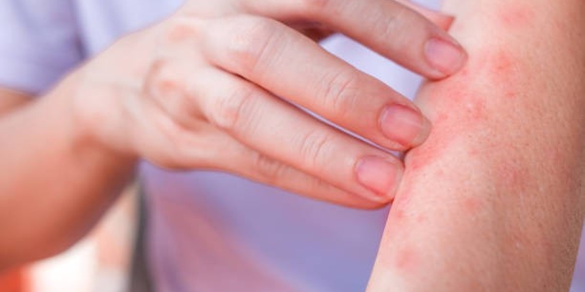 Tailored Treatments for Psoriasis: Discover Your Options in Riyadh