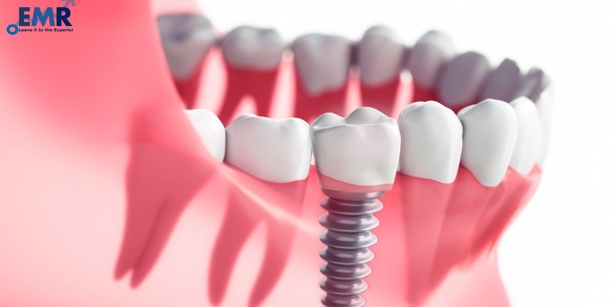 El Mercado de Implantes Dentales: Perspectivas de Crecimiento y Tendencias Futuras