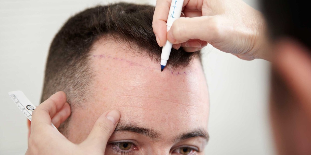 Why Hair Transplant Prices Vary in Riyadh