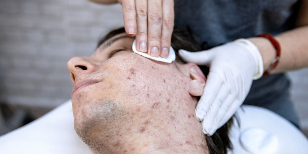 Acne Treatment Market Growth Overview & Industry Forecast Report 2033