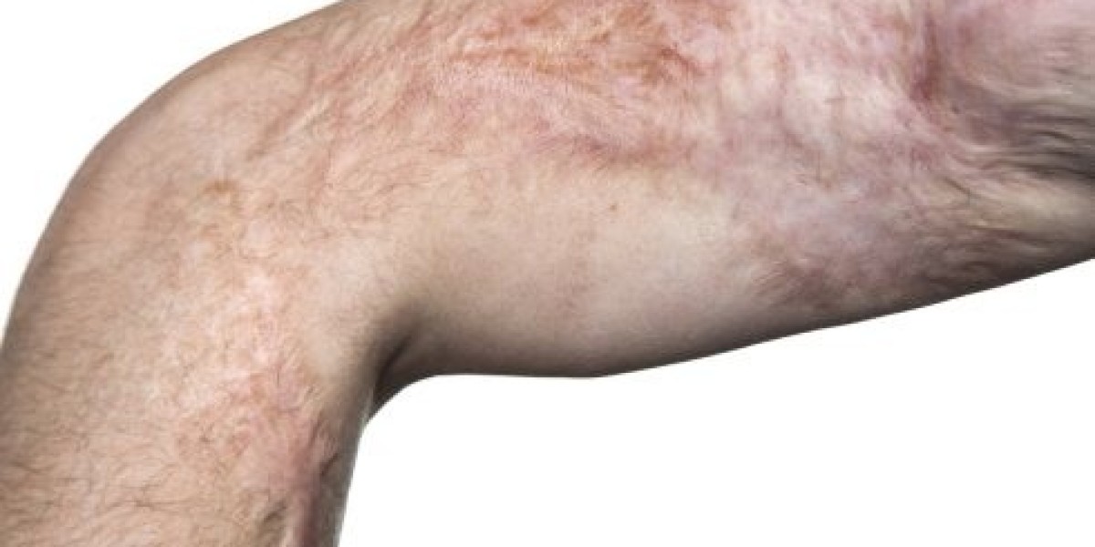 Healing Through Innovation: Explore Burn Reconstruction Surgery Options in Riyadh