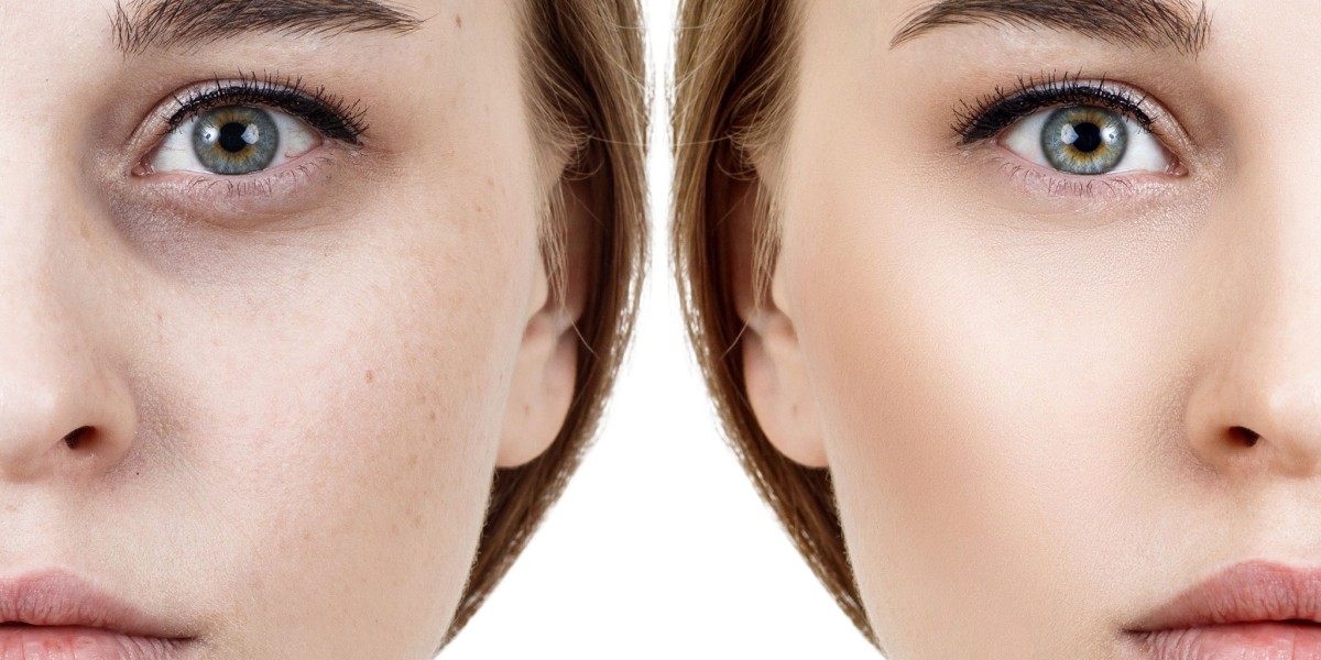 Dark Circles Treatment in Riyadh: Pricing, Clinics, and Results