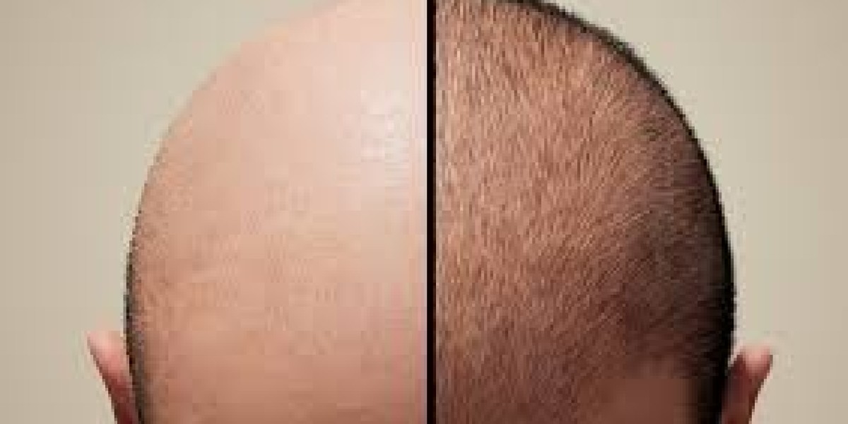 Dubai Hair Transplant: Understanding Your Choices