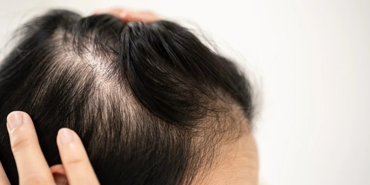 Alopecia Areata Market Growth and Future Prospects 2032