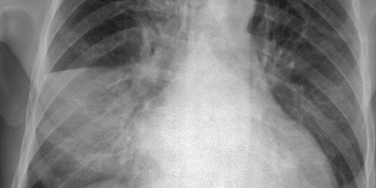 Levofloxacin respiratory infections
