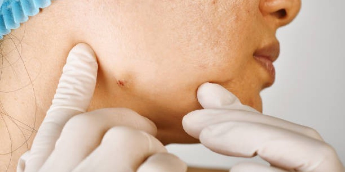 Understanding the Process of Dermoscopy Mole Evaluation