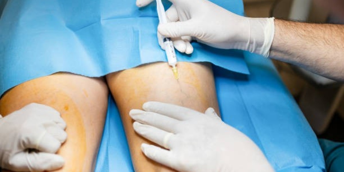 Who Needs Varicose Veins Treatment?