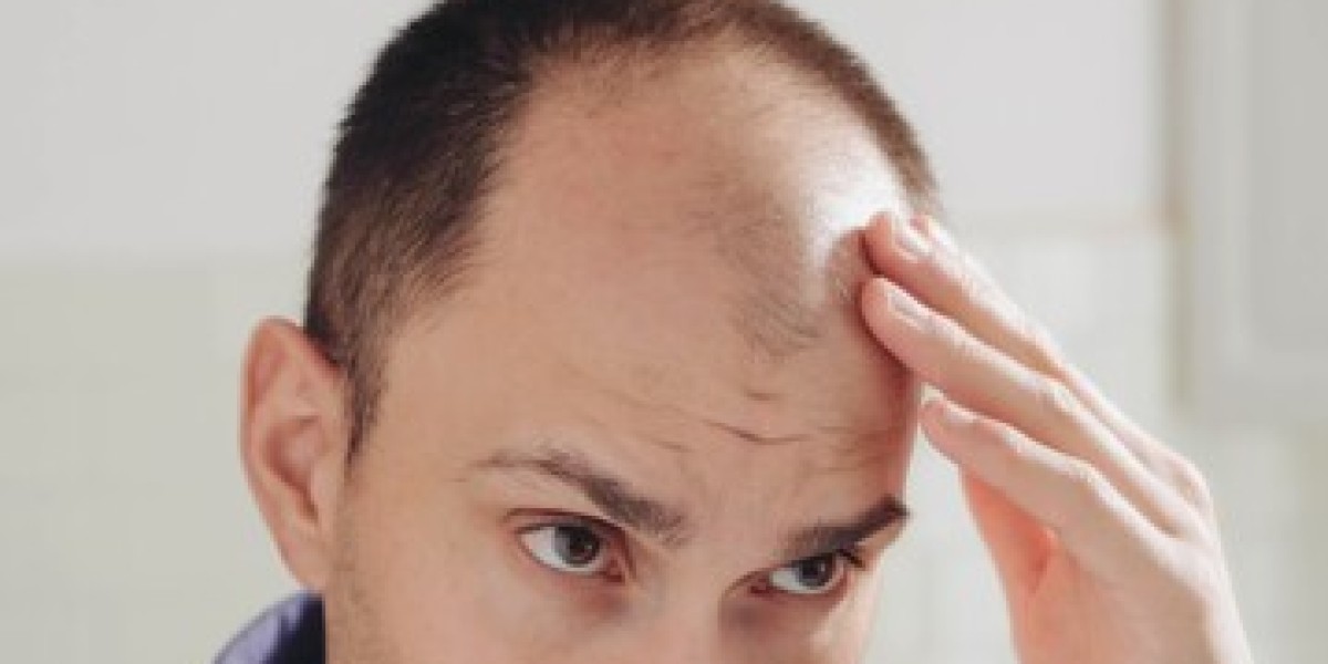 Exploring the Gender Differences in Hair Transplant Procedures in Dubai