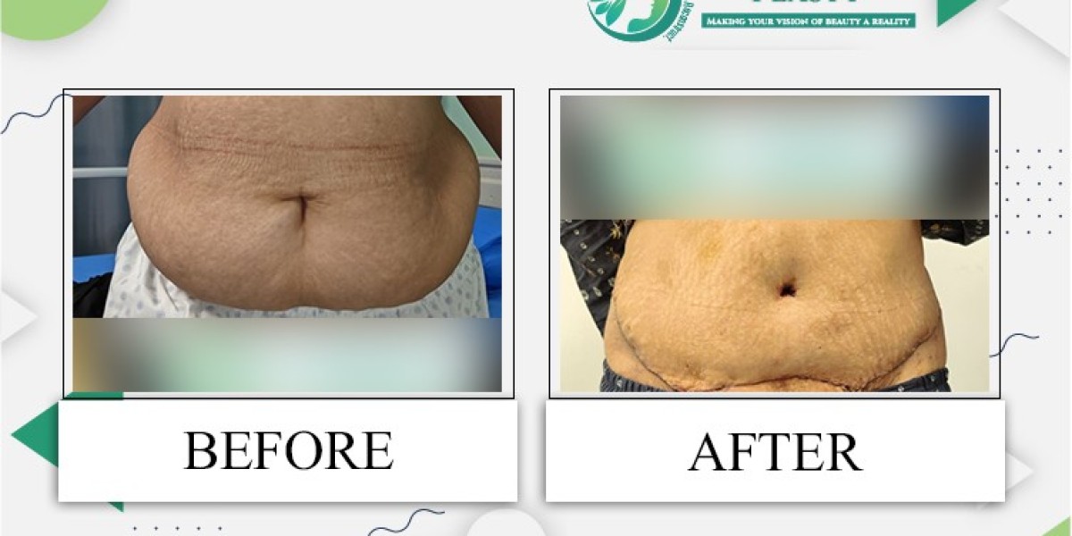 Tummy Tuck Surgery in Lahore Transform Your Body with Cosmeticoplasty