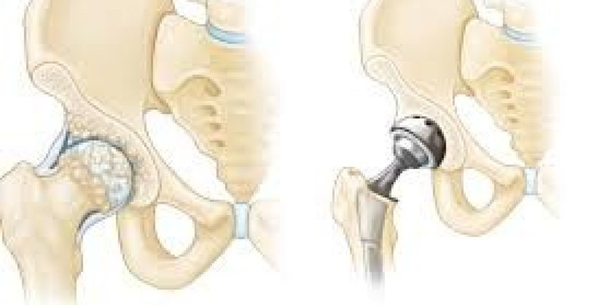 Understanding Joint Replacement Surgery and Its Benefits