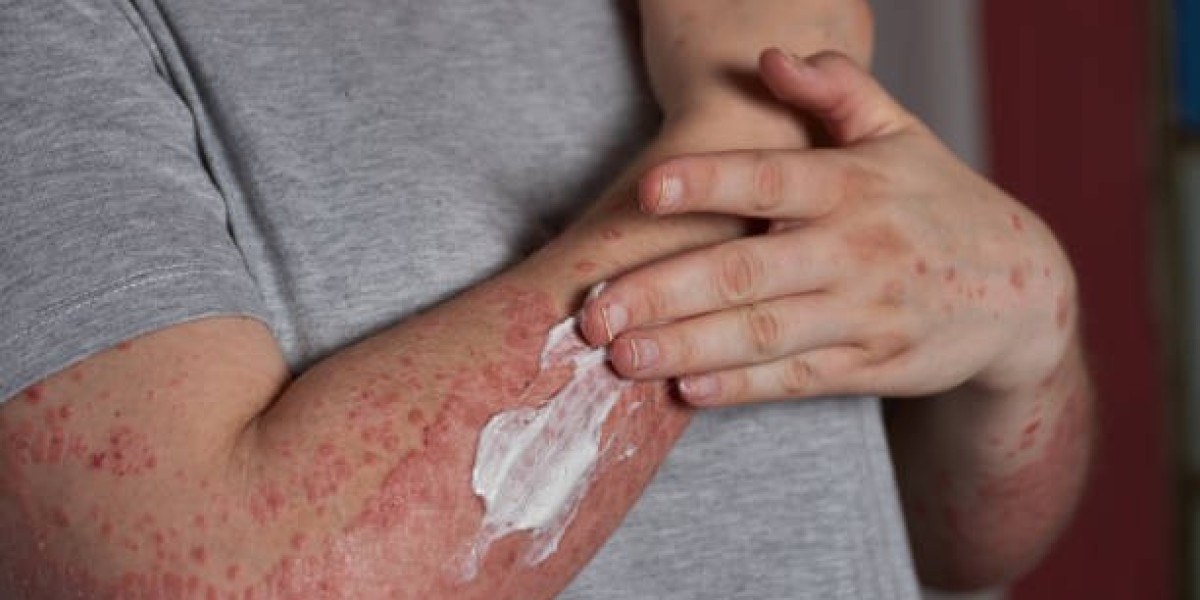 Your Guide to the Best Psoriasis Treatment in Riyadh