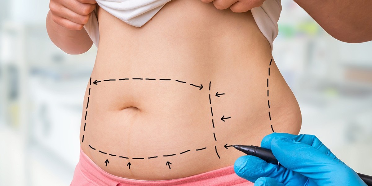 Liposuction Surgery in Dubai: The Role of Diet and Exercise Post-Procedure