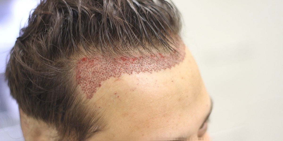 Hair Transplant Cost Breakdown: What Influences Prices in Dubai?