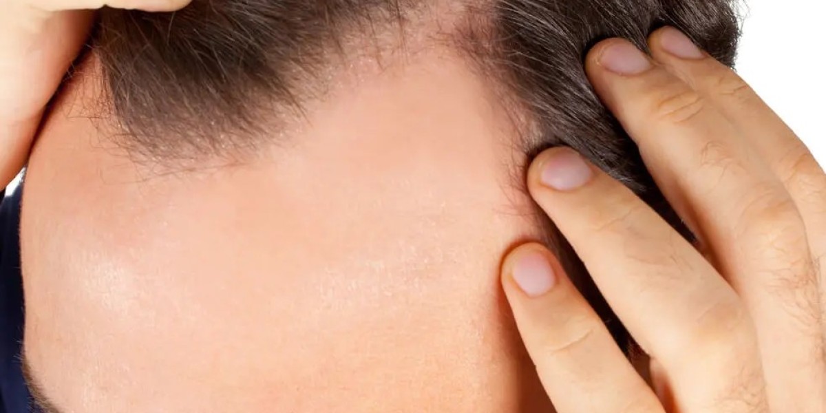Why Hair Transplant Costs Vary Across Dubai?