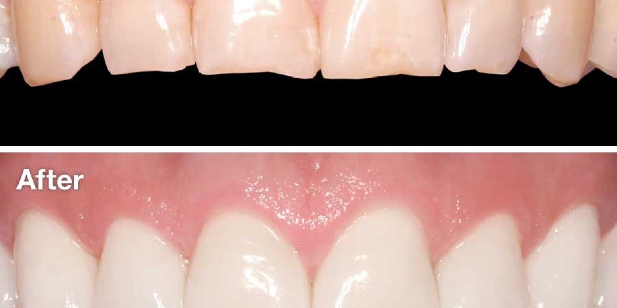 Everything You Need to Know About Dental Veneers in Dubai