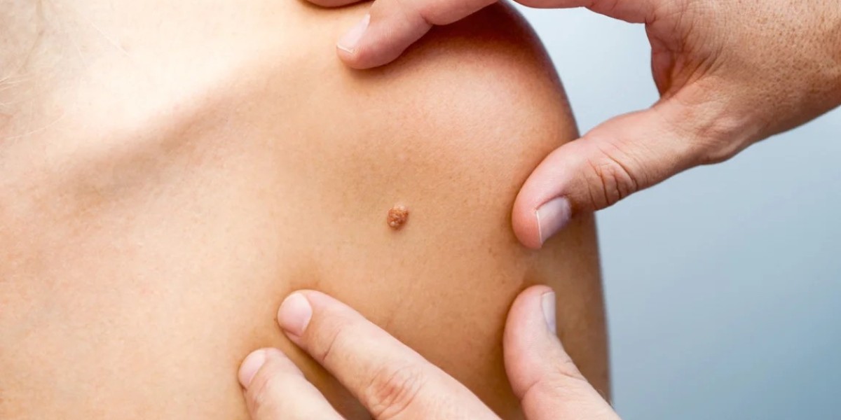 From Cryotherapy to Surgery: Skin Tag Removal Methods in Dubai