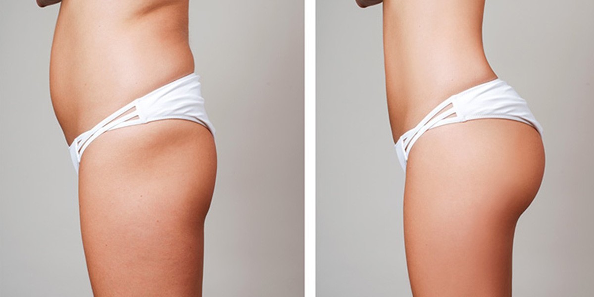 Enhancing Your Natural Beauty: The Art of Butt Fillers in Riyadh