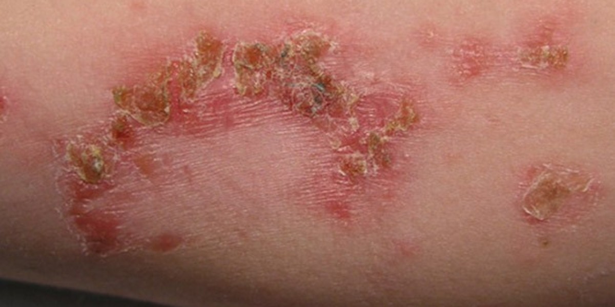 Bacterial infections - symptoms, causes and treatments