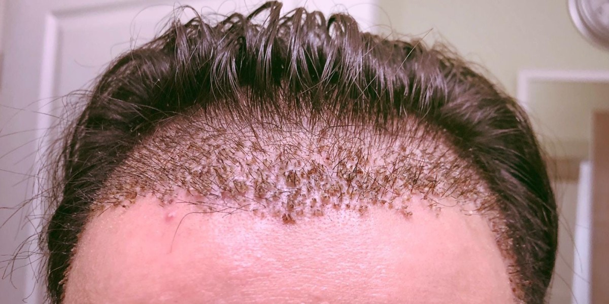 Hair Transplant in Dubai: A Hair Restoration Journey