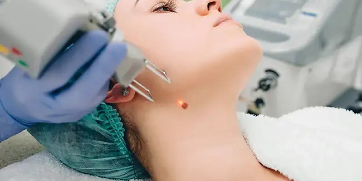 Explore Warts Removal Treatments Offered in Dubai Clinics