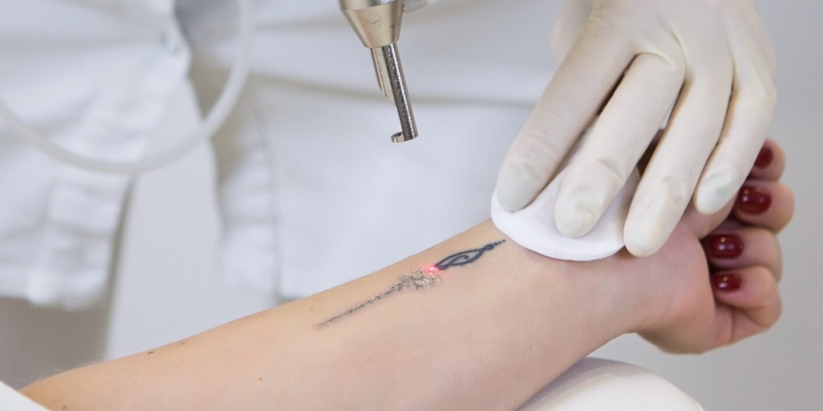 Get Rid of Old Tattoos with Laser Removal in Riyadh