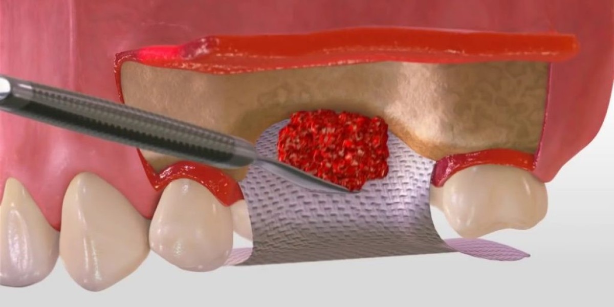 Dental Membrane and Bone Graft Substitute Market Poised for Strong Growth owing to Increasing Dental Implant and Bone Gr