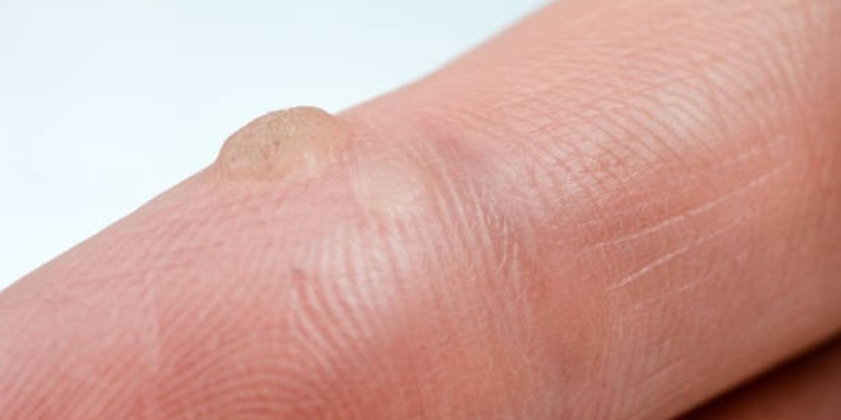 Maximize Your Recovery: The Benefits of Cryosurgery – Cryotherapy in Riyadh