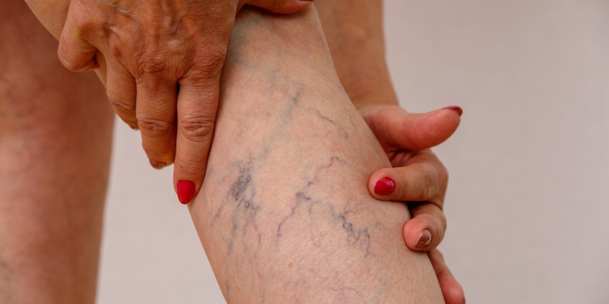 Safe and Effective Varicose Veins Solutions in Riyadh