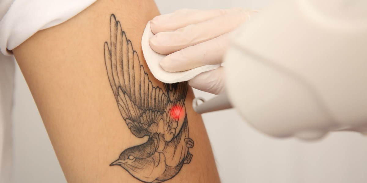 Safe and Efficient Laser Tattoo Removal Solutions in Dubai