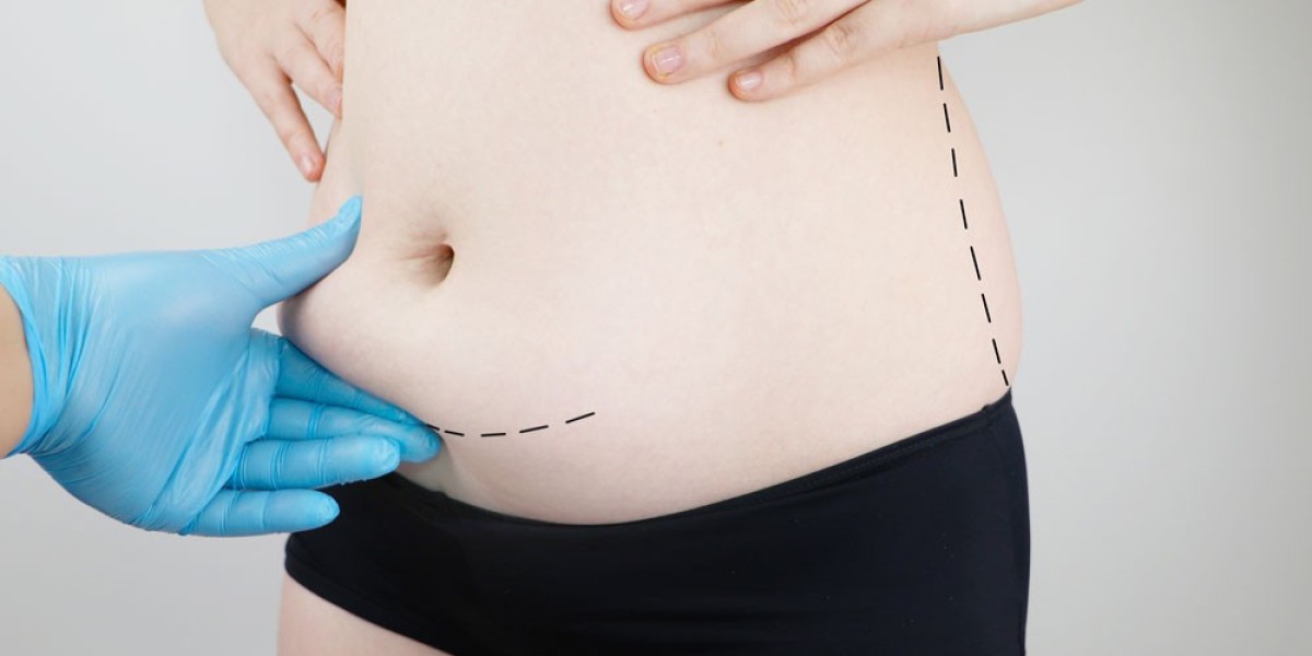 Tummy Tuck Dubai: Lifestyle Changes for Optimal Results