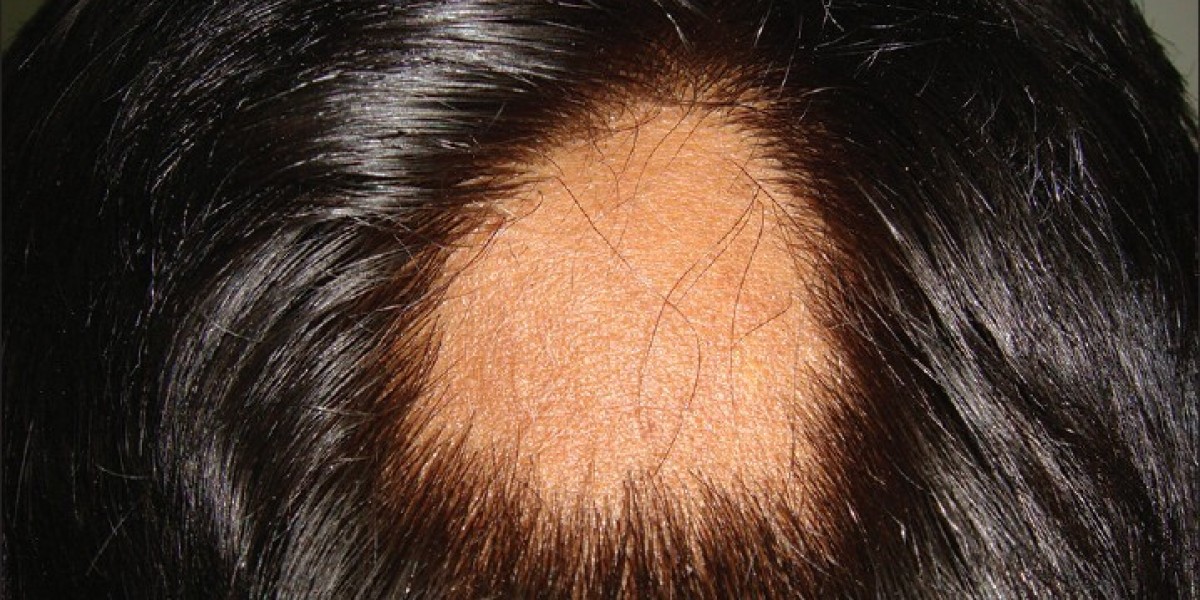 Best PRP Hair Treatment in Dubai: What Patients Say