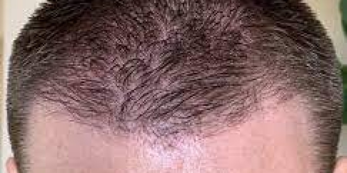 How Hair Transplants in Dubai Can Change Your Life