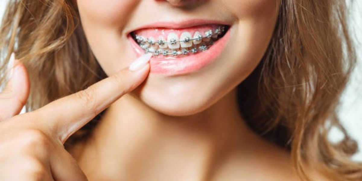 The Ultimate Guide to Metal Braces in Riyadh for Teens and Adults