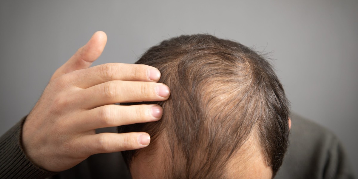 Preparing for Your Hair Transplant: Essential Tips