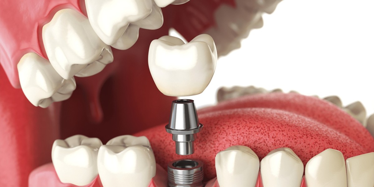 Long-Term Care for Dental Implants: Tips for Lifelong Health
