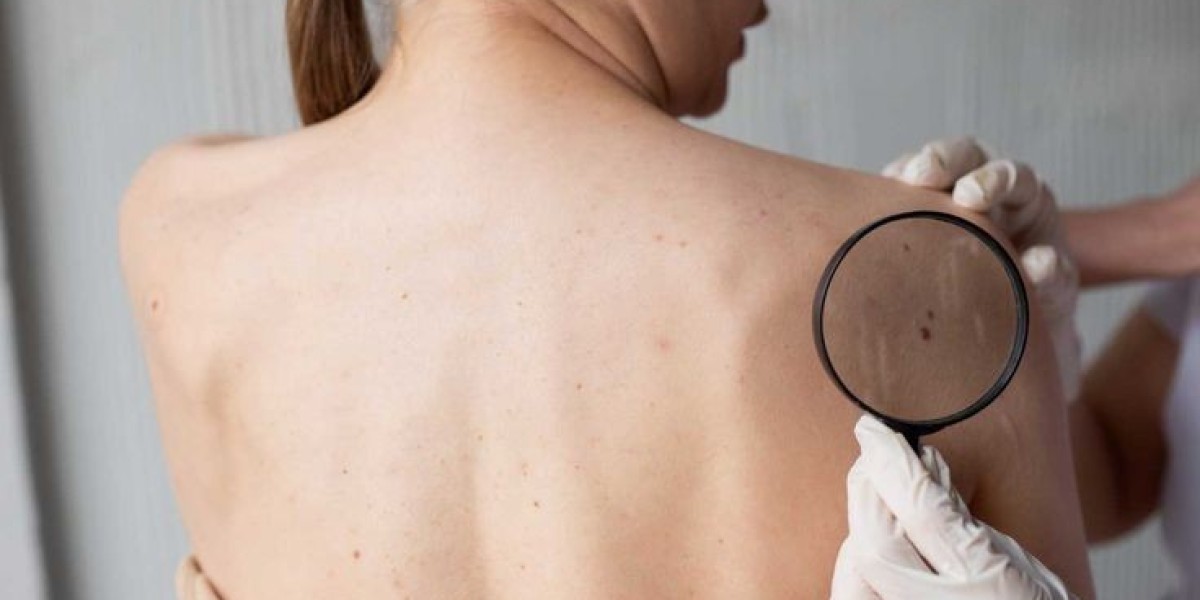 Your Path to Clear Skin: Understanding Skin Tag Removal Treatment