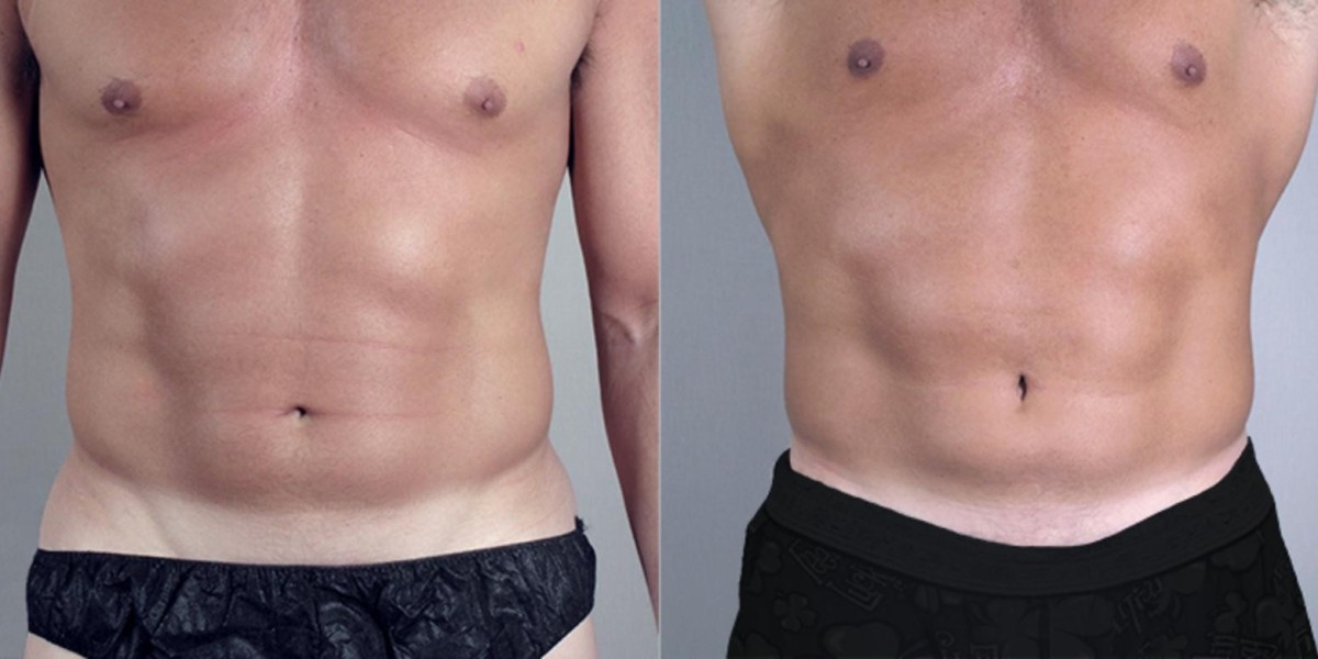 The Complete VASER Liposuction Experience in Riyadh: From Consultation to Recovery