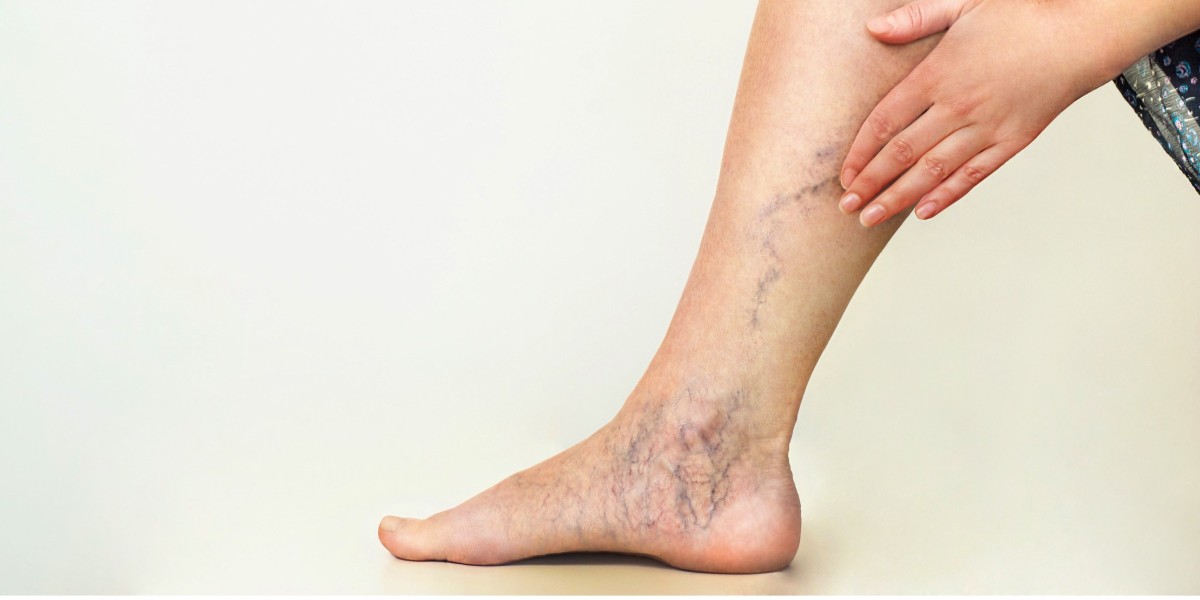 Top Hospitals Offering Varicose Veins Treatment in Riyadh