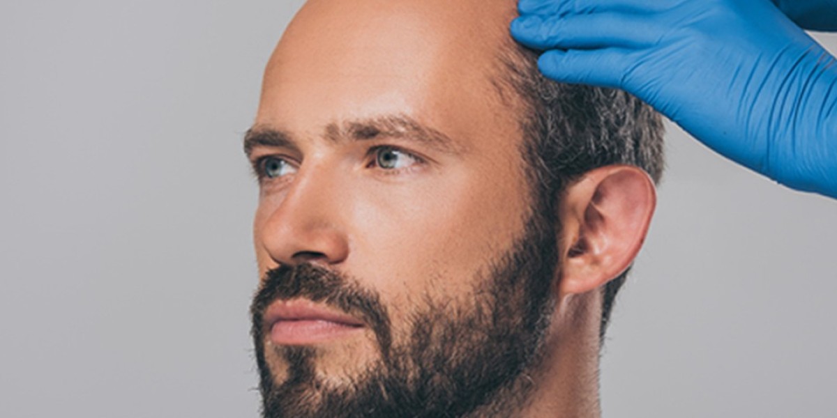 PRP Hair Treatment in Jumeirah, Dubai: A Natural Solution for Hair Restoration