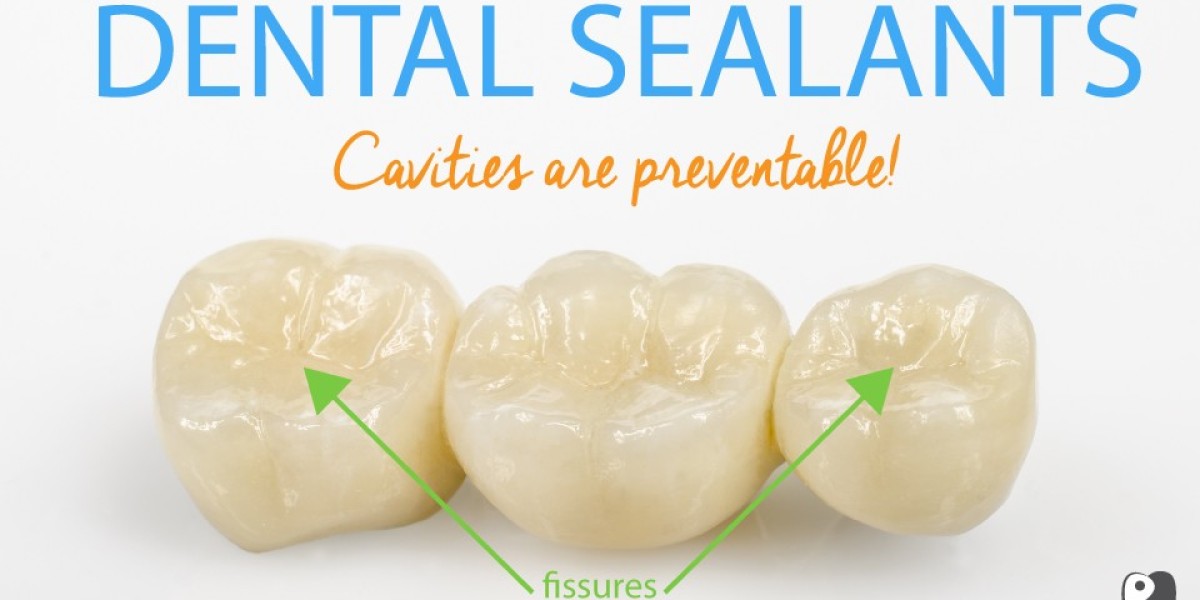 The Benefits of Dental Sealants for Cavity Prevention
