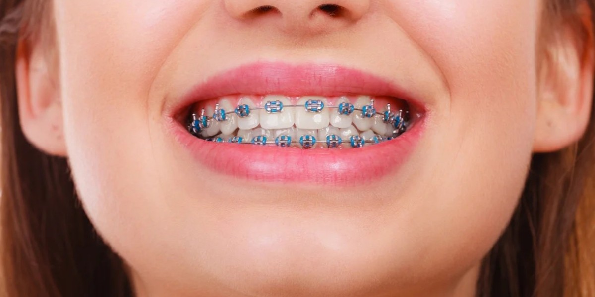 Financing Options for Dental Braces in Dubai: Making It Affordable