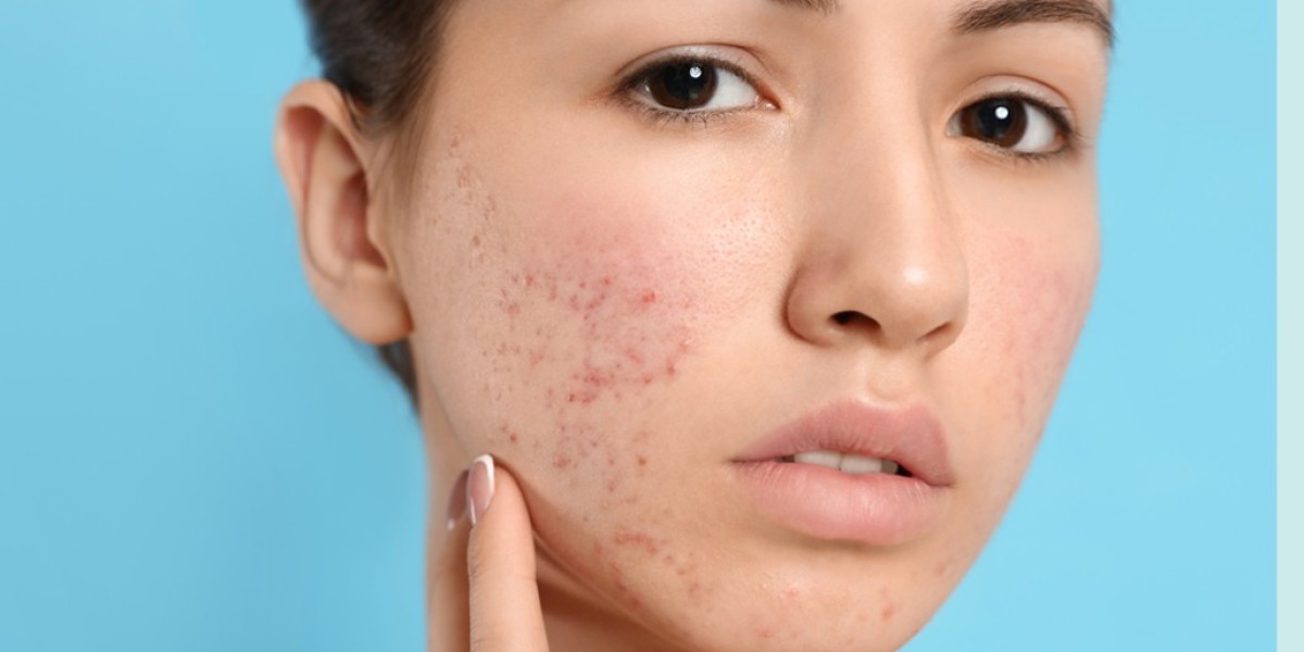Your Guide to Acne Scar Lasers and Peels in Riyadh