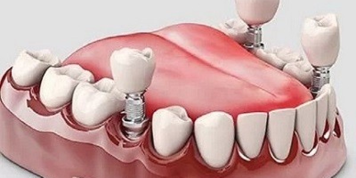 Dental Implants: The Ultimate Tooth Replacement Option